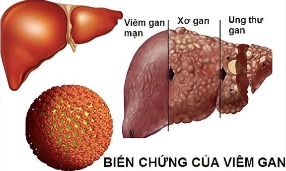 Biến chứng của viêm gan