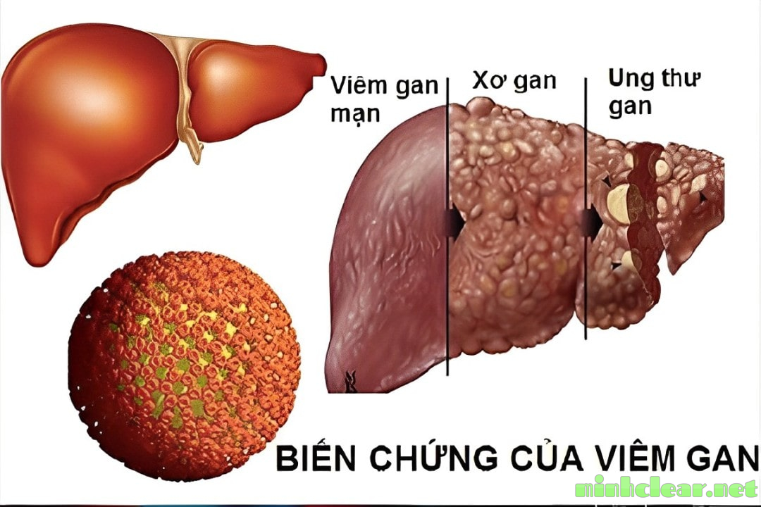 Biến chứng của viêm gan